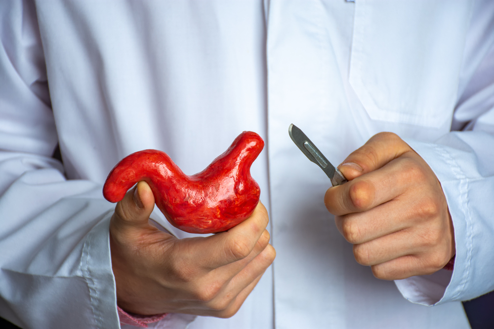 Indicação de Cirurgia Bariátrica